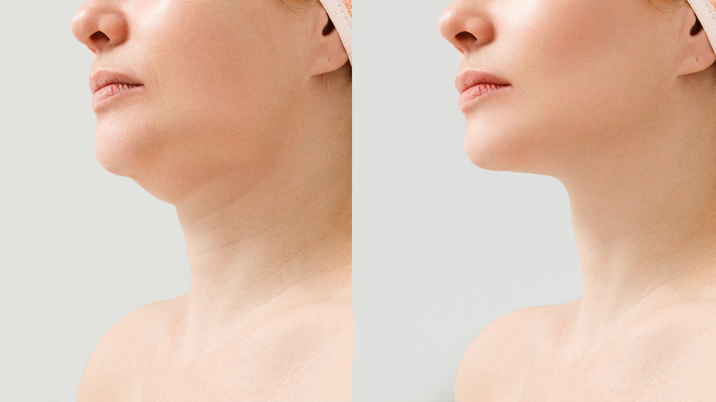 Sleep positioning after chin liposuction can make or break your results. Discover the exact elevation angles, week-by-week timeline, and setup strategies surgeons recommend — before your procedure.