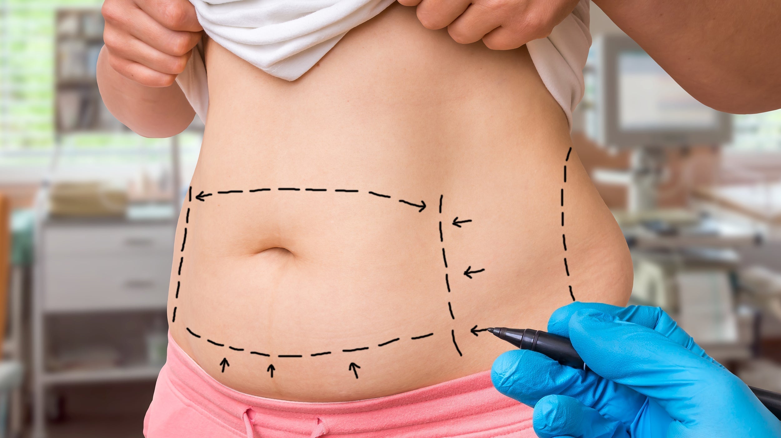 Sleeping wrong after a combined BBL and tummy tuck can cost you results. Here's the positioning system that protects both procedures at once.