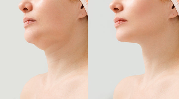 Sleep positioning after chin liposuction can make or break your results. Discover the exact elevation angles, week-by-week timeline, and setup strategies surgeons recommend — before your procedure.